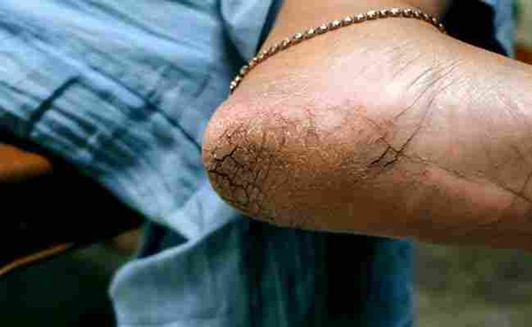 ठंड में क्या आपकी भी एड़ियां गईं हैं फट निकलने लगा है खून तो आजमाएं ये घरेलू नुस्खा :